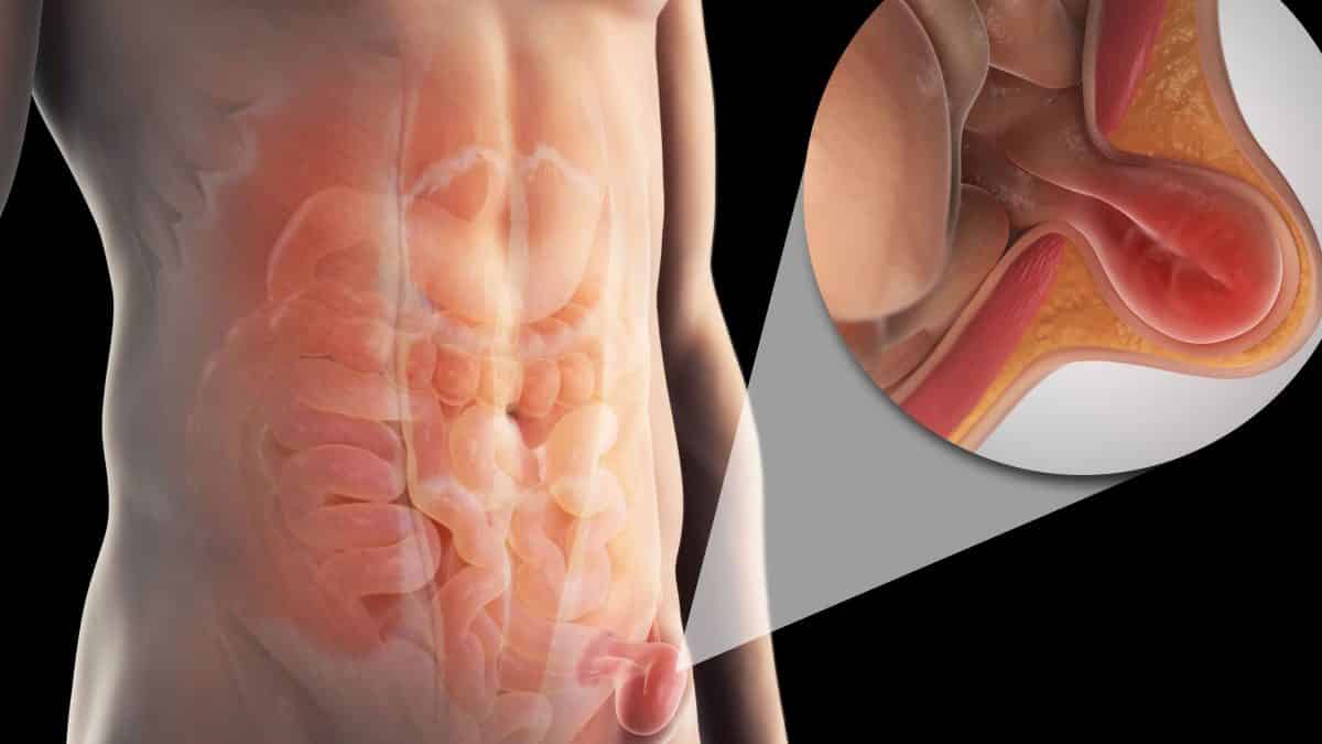Mecatlán: Cirugías de Hernia y Vesícula